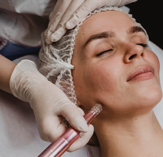 Melasma Laser Facial05