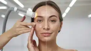Microneedling vs. Laser Treatments: A Clear Winner for Your Anti-Aging Goals?