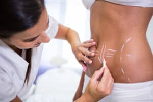 Non-surgical body contouring treatment on abdomen targeting stubborn fat