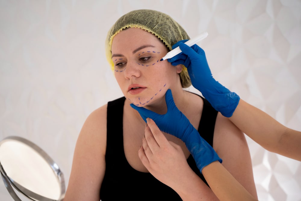PDO threads being placed under facial skin during thread lift procedure