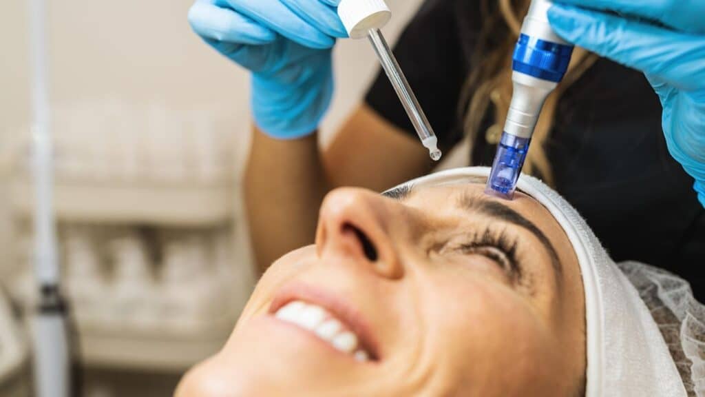 PRF microneedling treatment showing platelet-rich fibrin applied with microneedling device