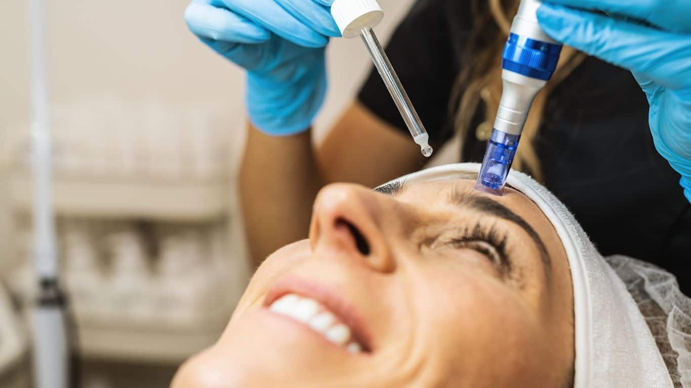 PRF microneedling treatment showing platelet-rich fibrin applied with microneedling device