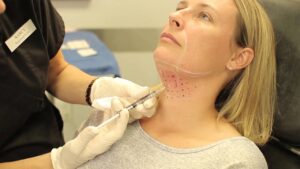 Kybella injection being administered under the chin for fat reduction