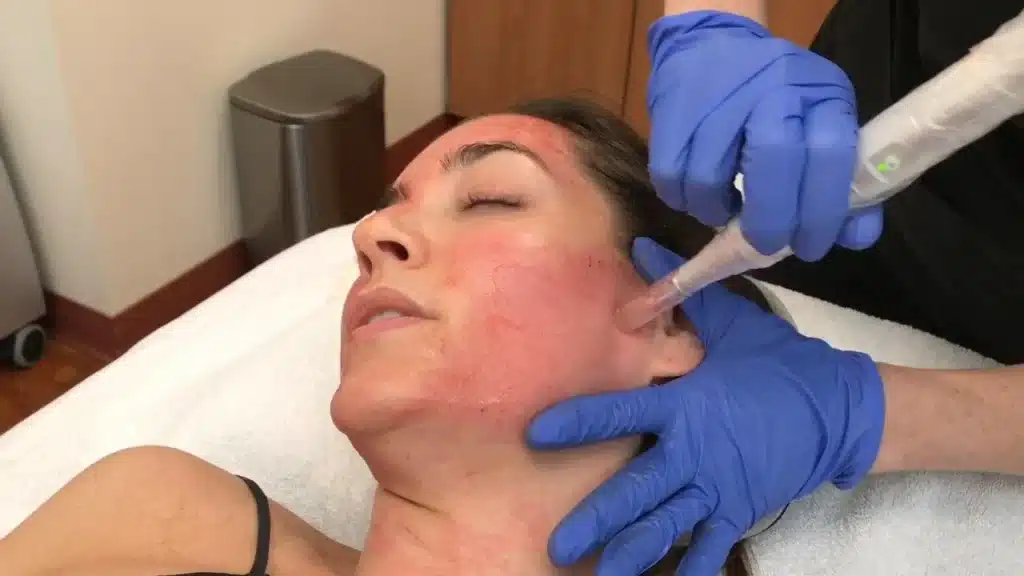 PRF vs PRP microneedling treatment comparison showing platelet concentration differences