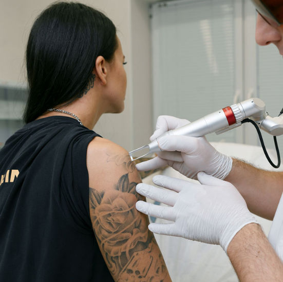 tatto Removal Services