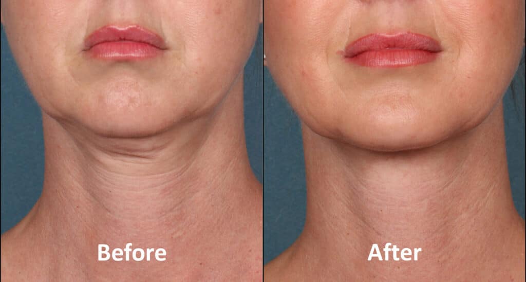 kybella treatment from eye candy med spa in lakewood ca