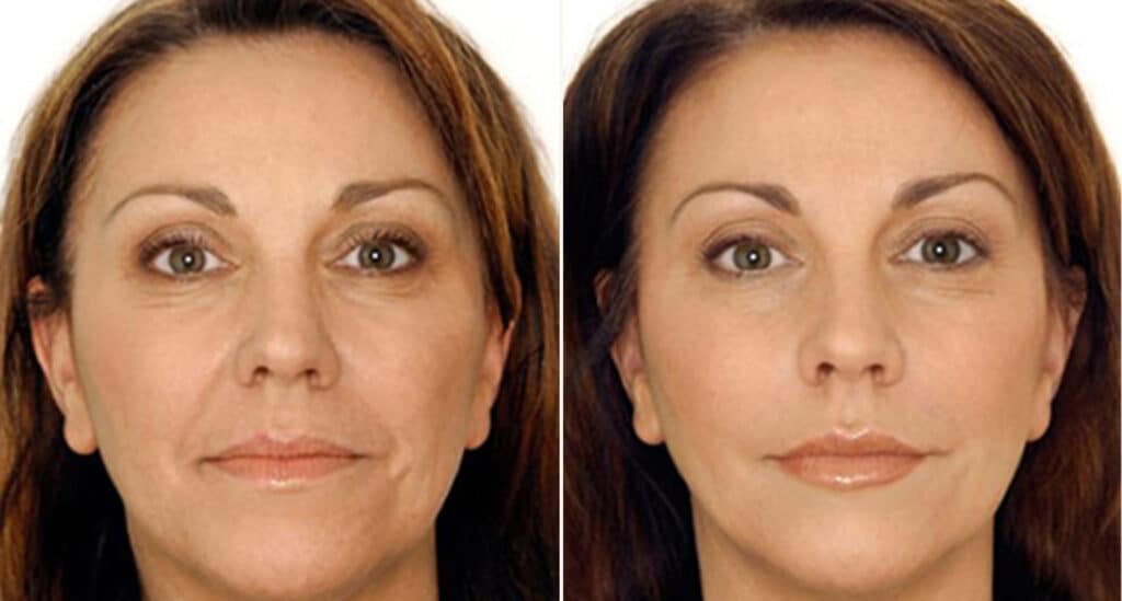 Juvederm, Restylane, and Sculptra filler comparison chart 2026