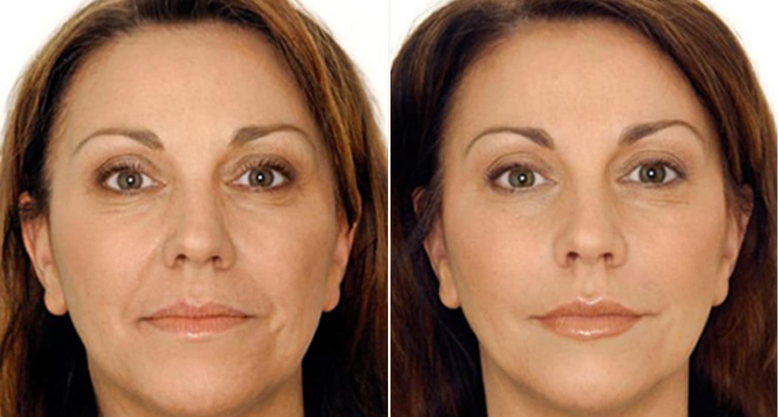 Juvederm, Restylane, and Sculptra filler comparison chart 2026