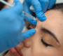 botox buena park 5 1 90x80