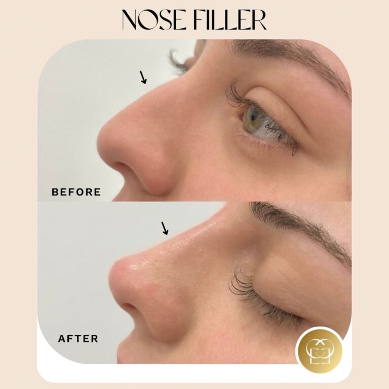 Nose fillers in orange county