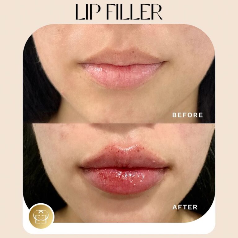 lip fillers in orange county