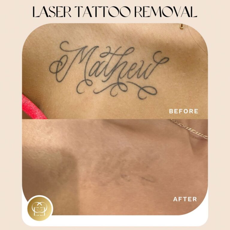 Tattoo removal in orange county