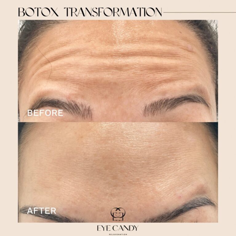 botox in orange county