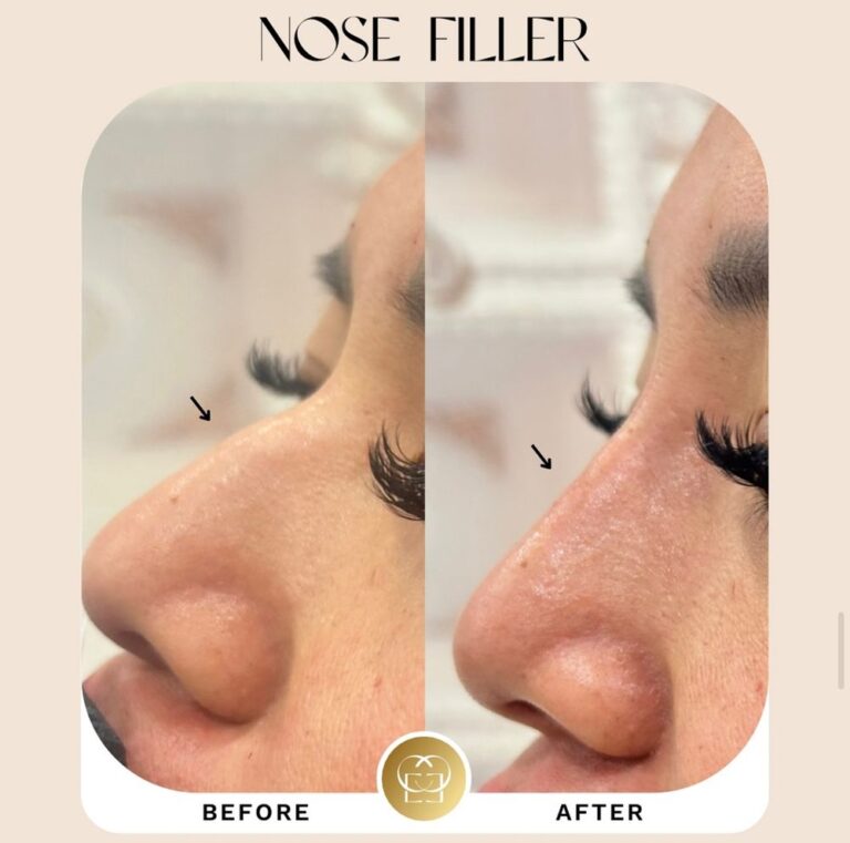 nose filler in orange county