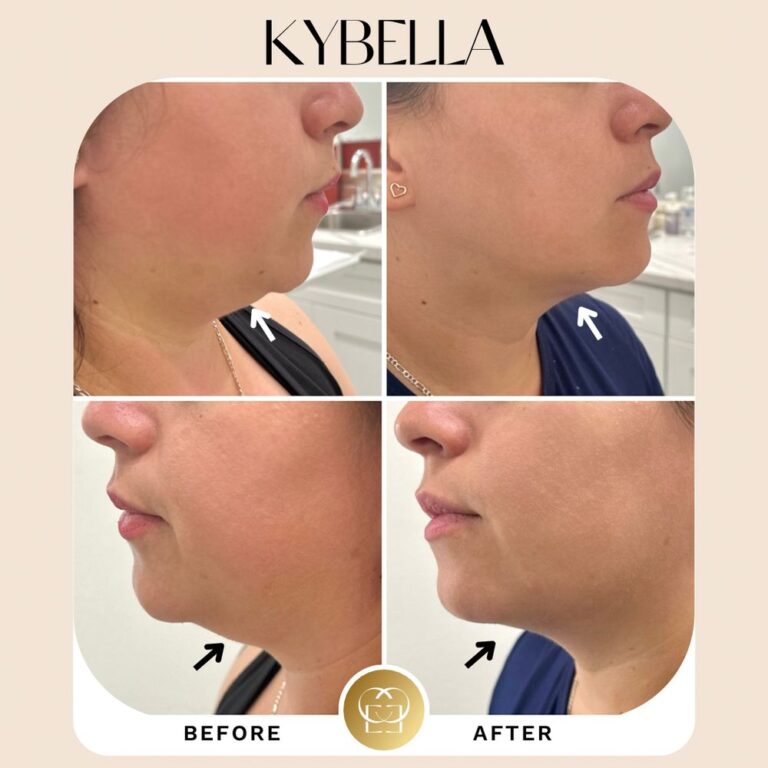 kybella treatment in orange county