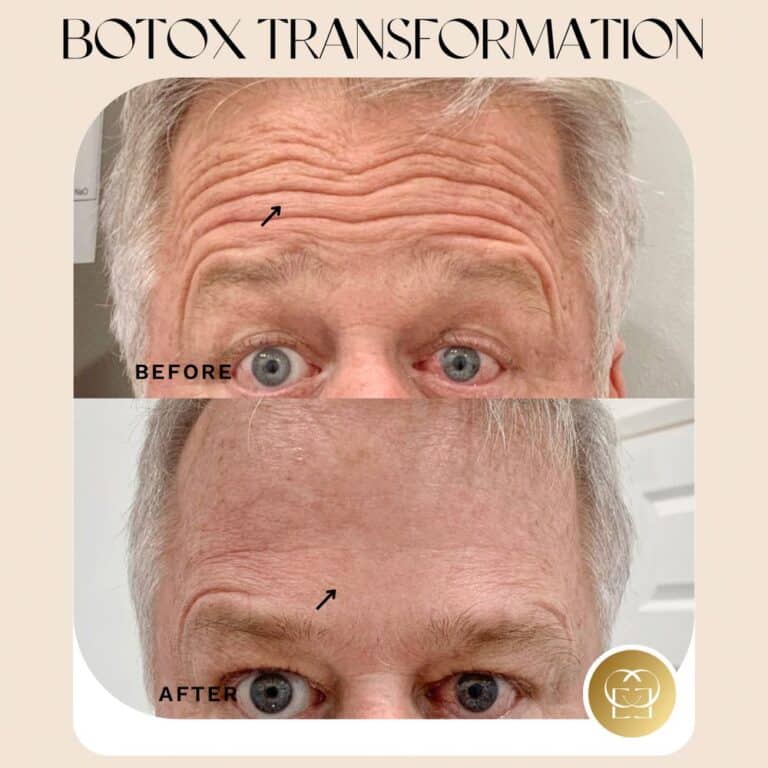 botox treatment in orange county