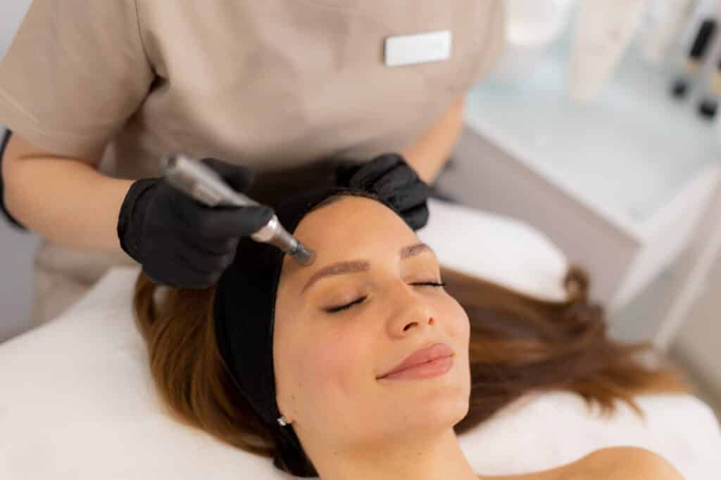 Can You Get Microneedling If You Have Rosacea