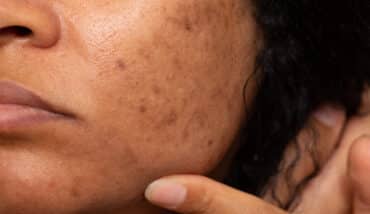 melasma laser treatment in southern california