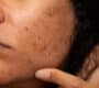 melasma laser treatment 2 90x80