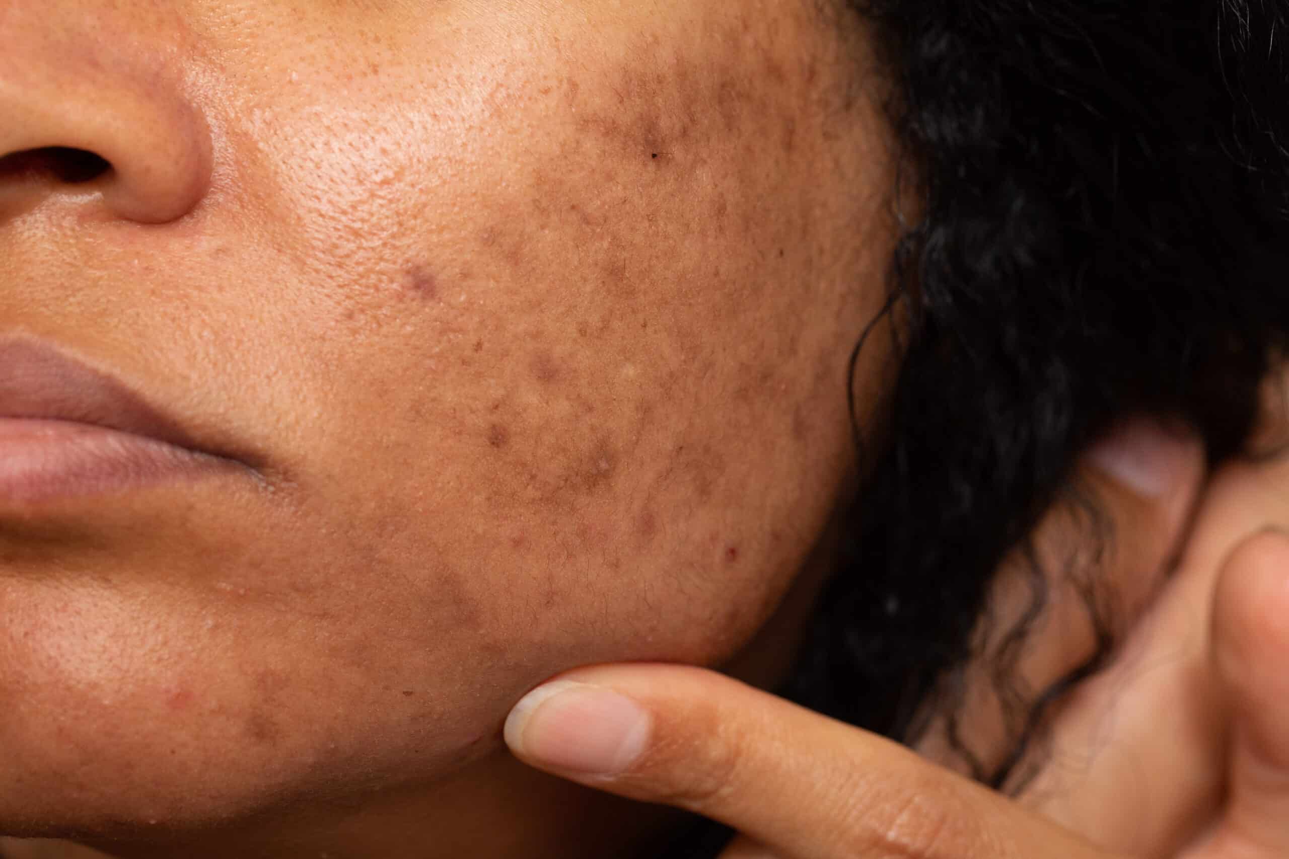 melasma laser treatment in southern california