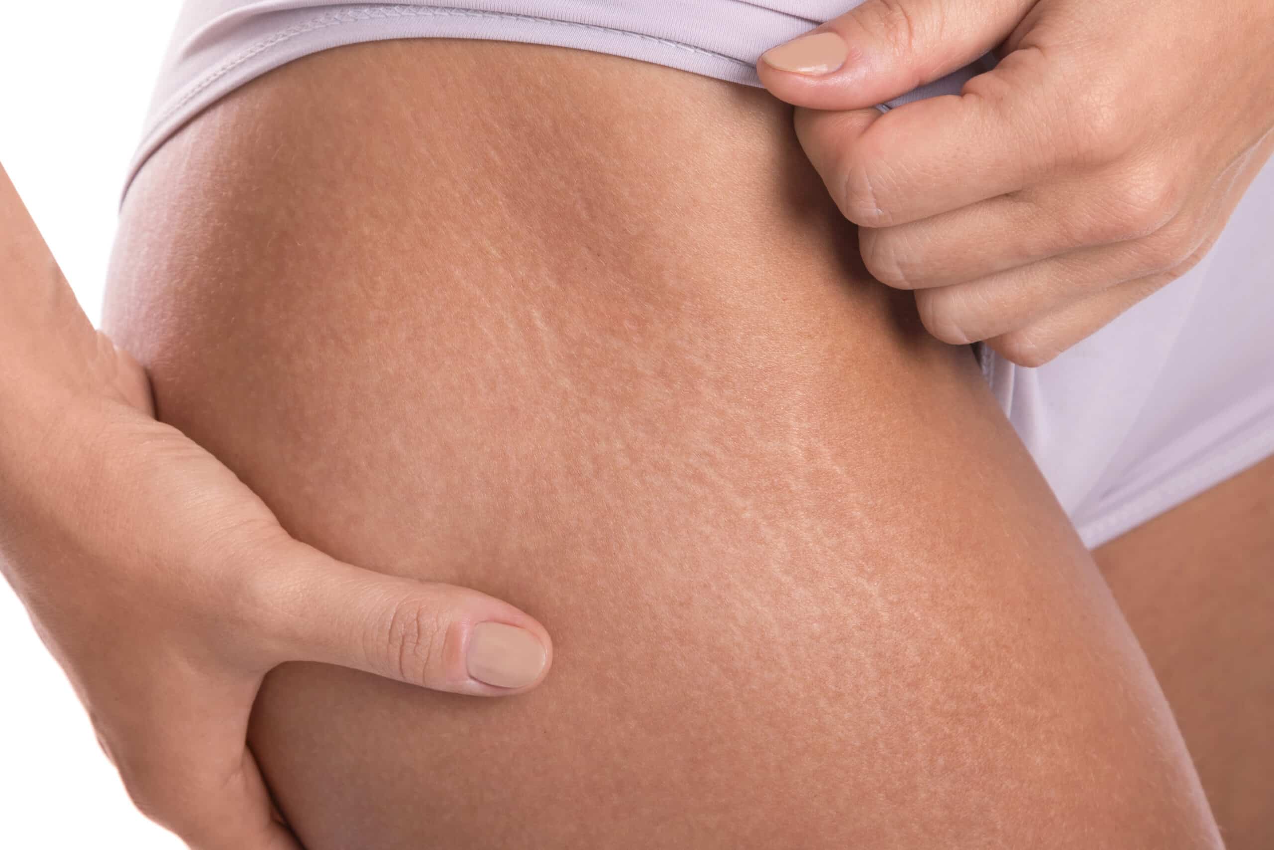 Stretch mark camouflage tattooing consultation at Eye Candy Medspa in Buena Park