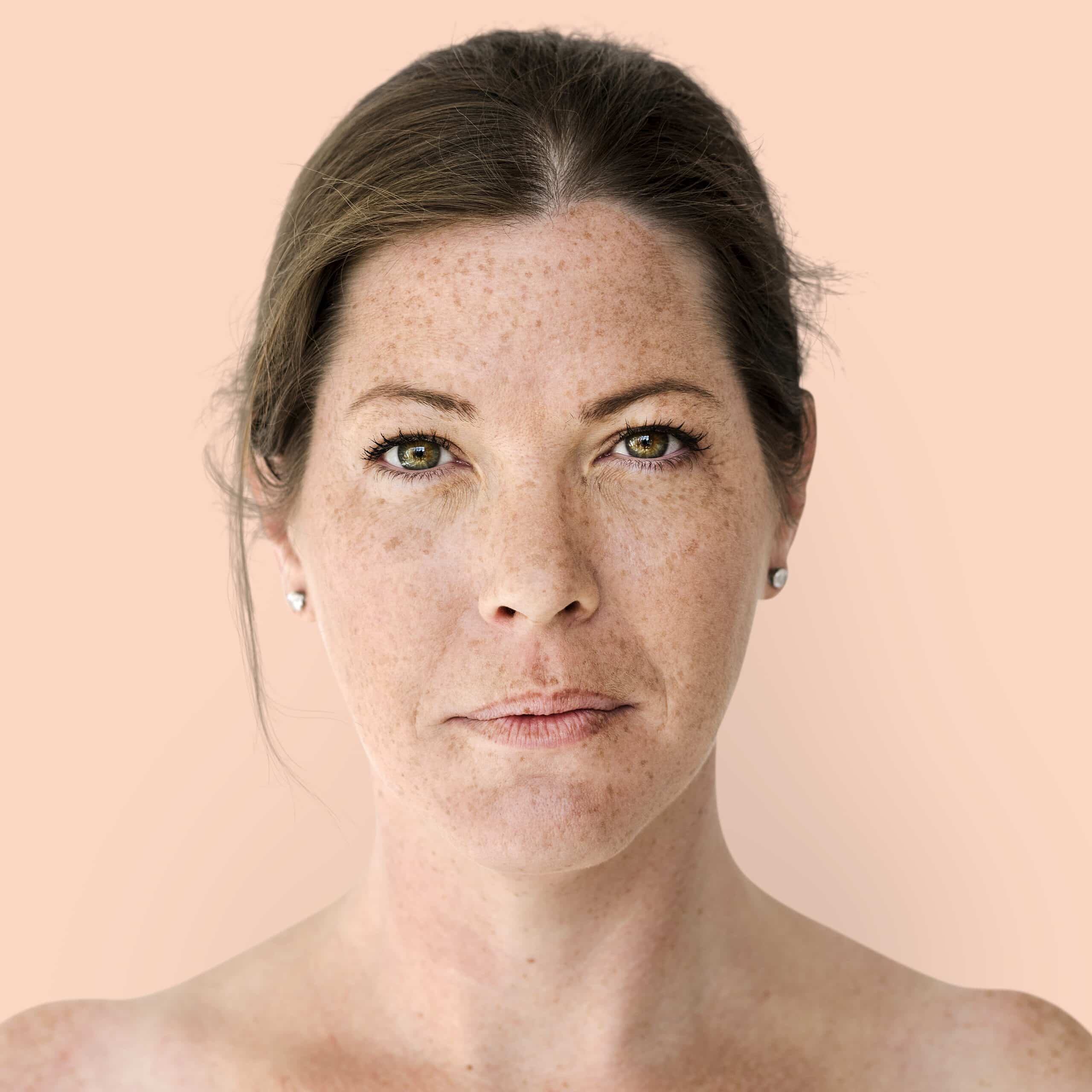 Melasma treatment consultation at Eye Candy Medspa in Buena Park